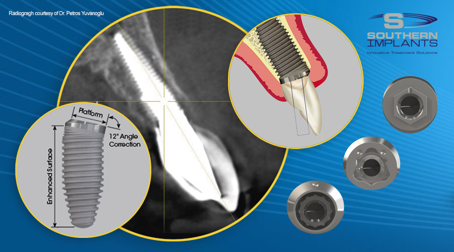 CoAxis Implants for Subcrestal Angle Correction Southern Implants