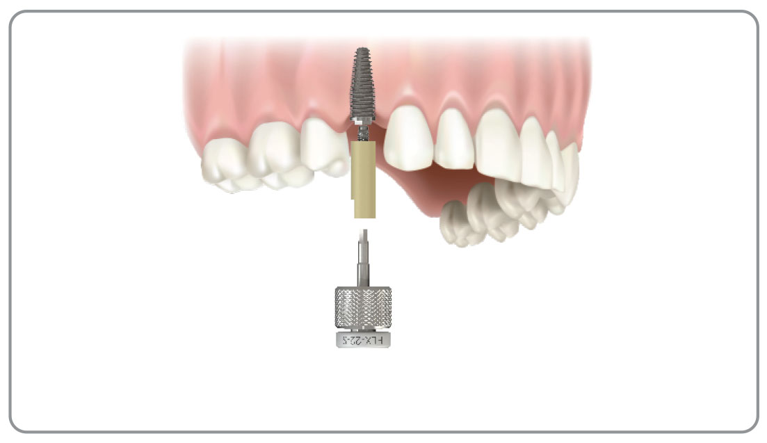 Scan Flag/Scan Body Southern Implants