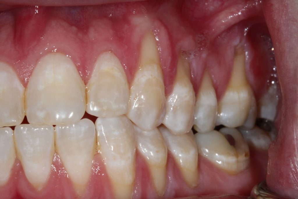 Gum Grafting Southern Roots Periodontics