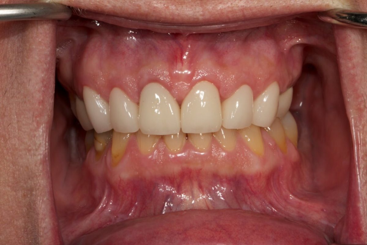 Crown Lengthening Southern Roots Periodontics