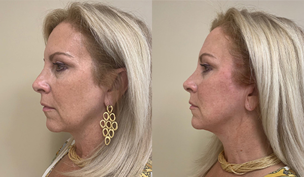 Thread Lift Mid Face South Florida Dermatology