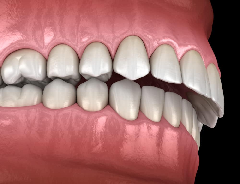 How to Correct Overbite Without Surgery