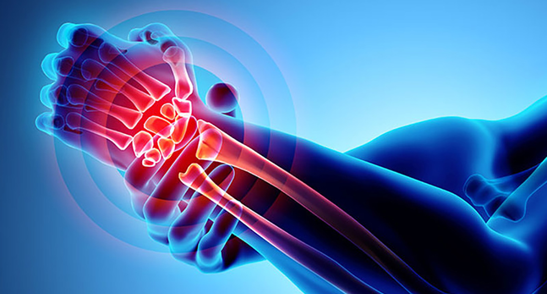 Arthritis Physiotherapy at Southside Physio Foxrock Dublin 18