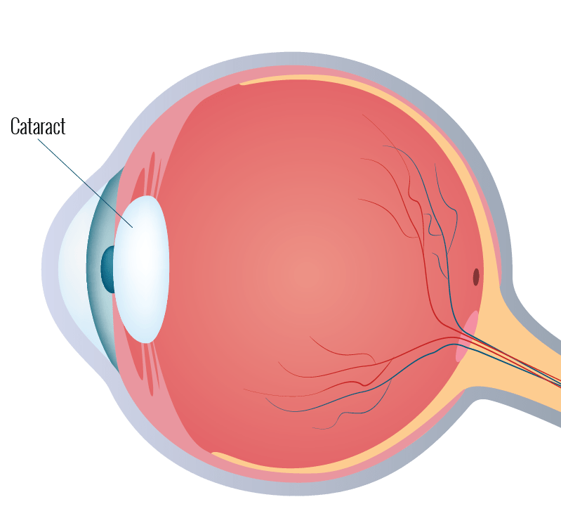 Eye Care Associates Tulsa Tulsa Car Accident Attorney Lawter