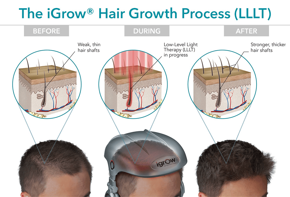 Hair Loss Treatment in Singapore What's getting results in 2019