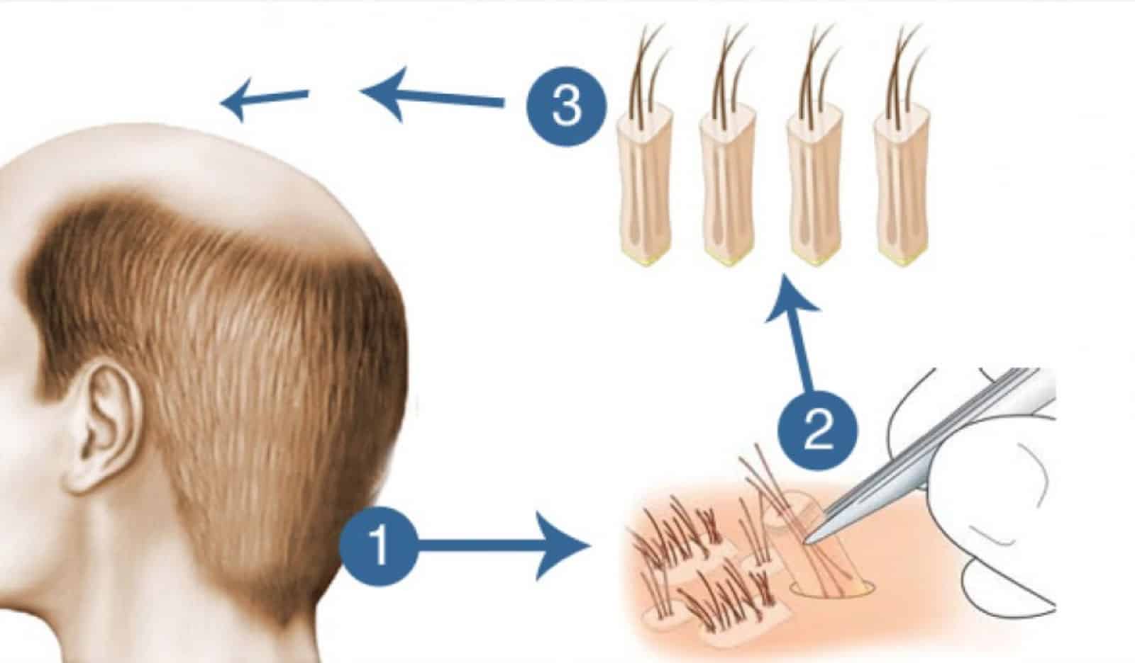Hair Transplant Singapore Best Results Available in 1 Session
