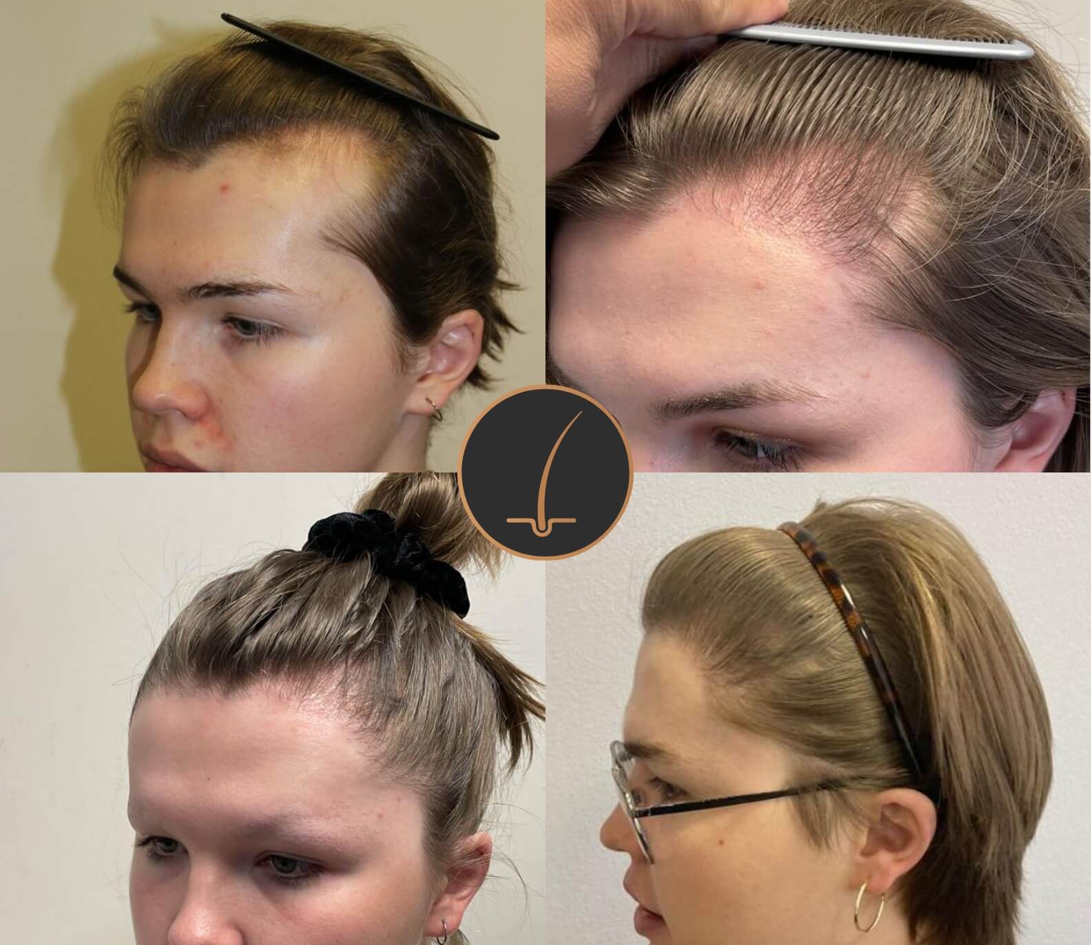 Hair Transplant UK Cost Hair Transplant Finance Enhance Hair