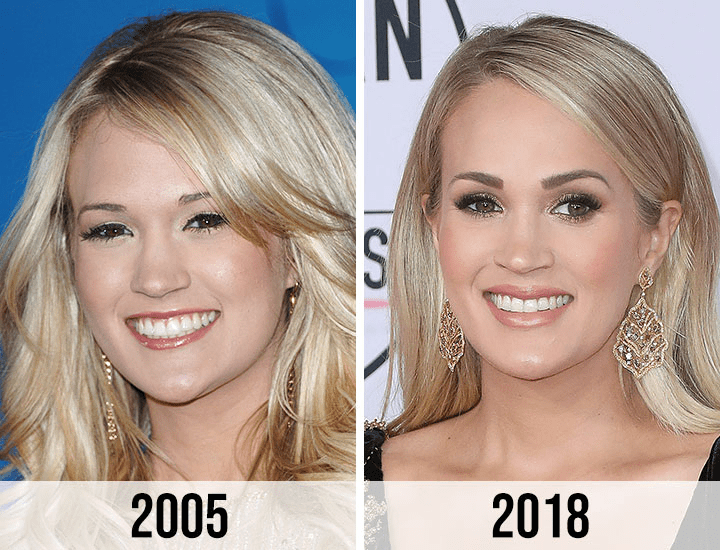 Carrie Underwood Plastic Surgery A Detailed Analysis