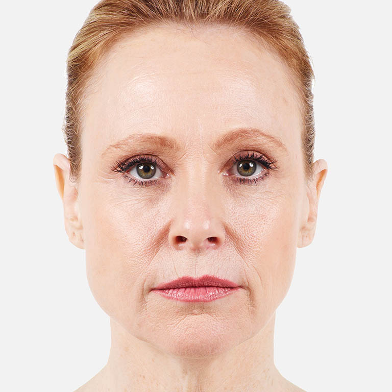 Denver Medical Spa & Skin Care Clinic Juvéderm XC & Plus