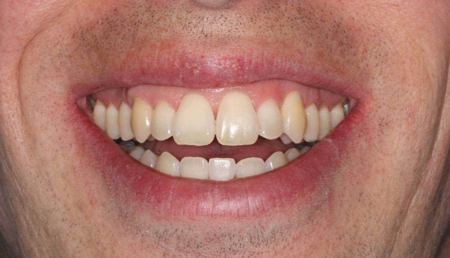 Invisalign Leamington Spa Dentist Leamington Spa