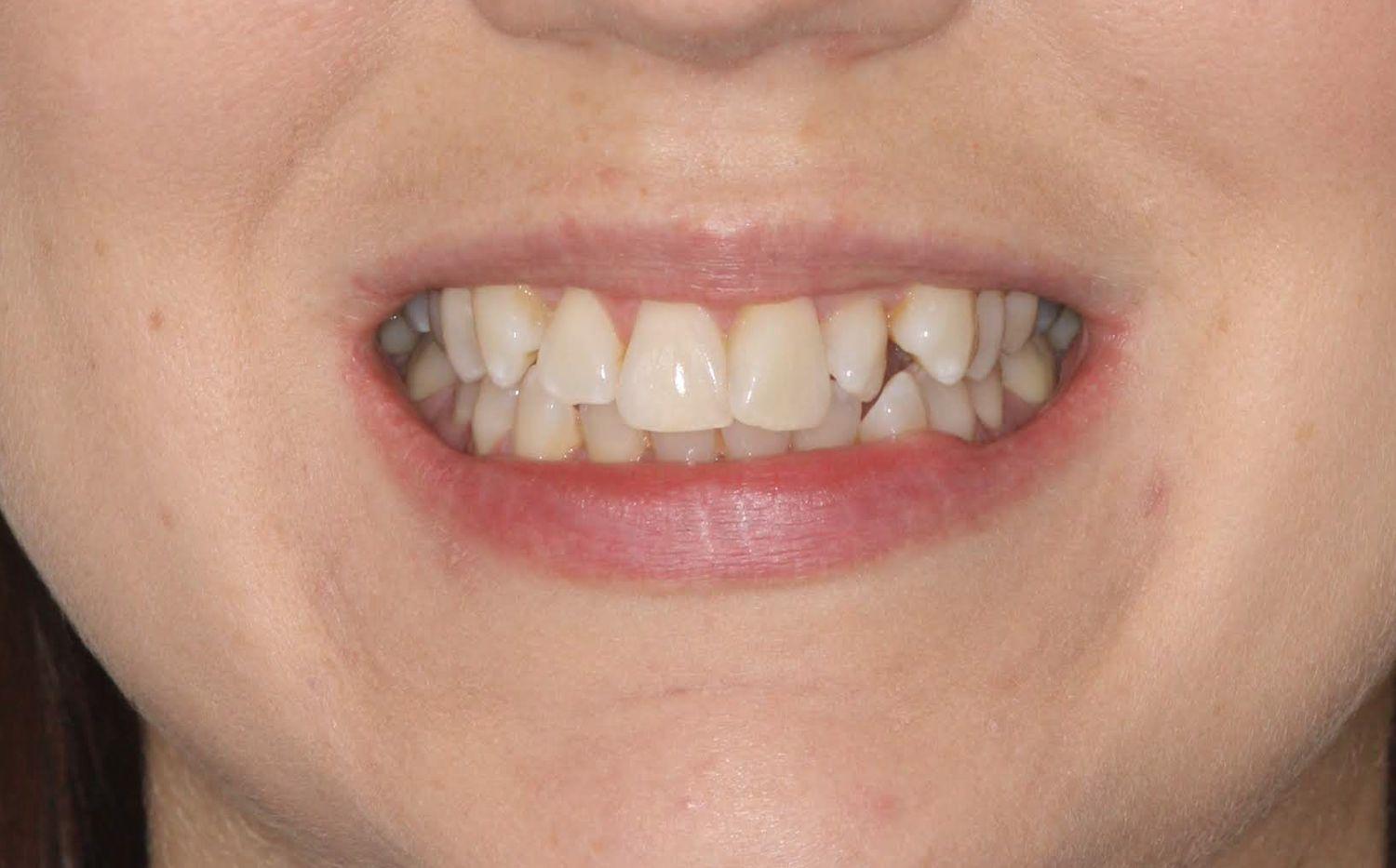 Invisalign Leamington Spa Dentist Leamington Spa