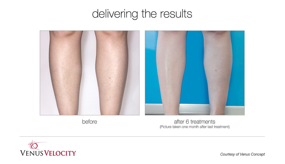 Laser Hair Removal Ottawa Spa Olivia Laser Hair Removal, Waxing, Lash Lifts