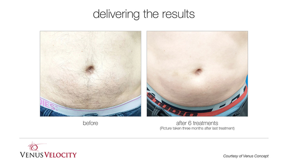 Laser Hair Removal Ottawa Spa Olivia Laser Hair Removal, Waxing, Lash Lifts