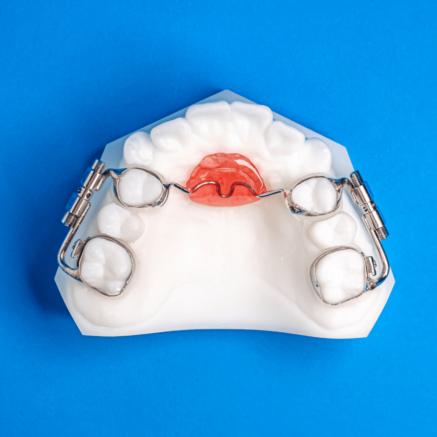 Rapid Molar Distalizer Specialty Appliances