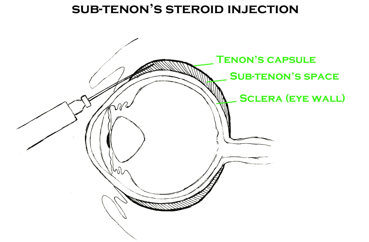 Steroid Injections Retina Medication Retina Injection Therapy