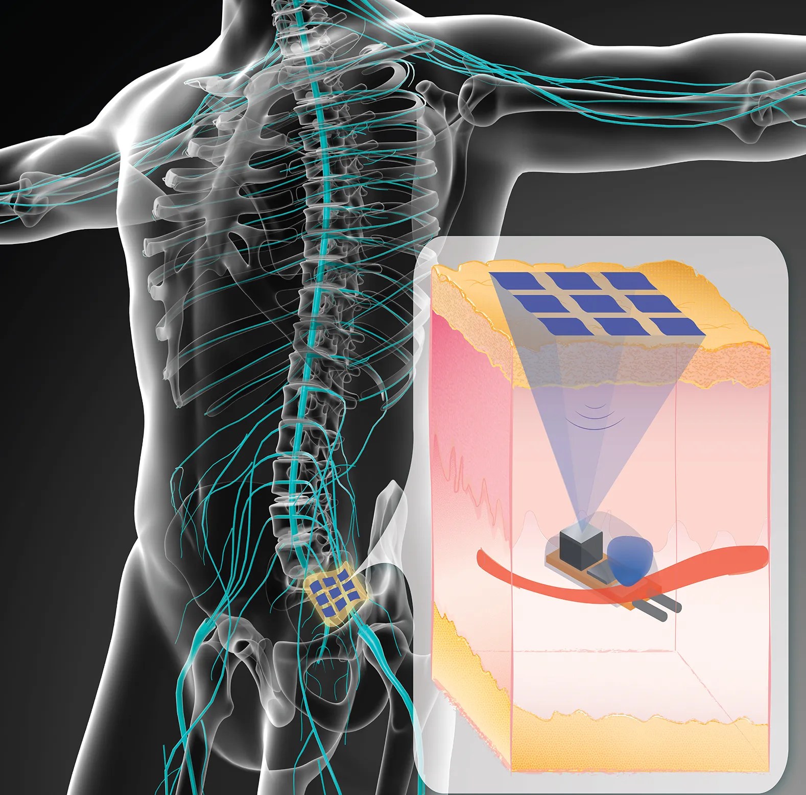 UltrasoundPowered Nerve Implant Works Deep in Body IEEE Spectrum