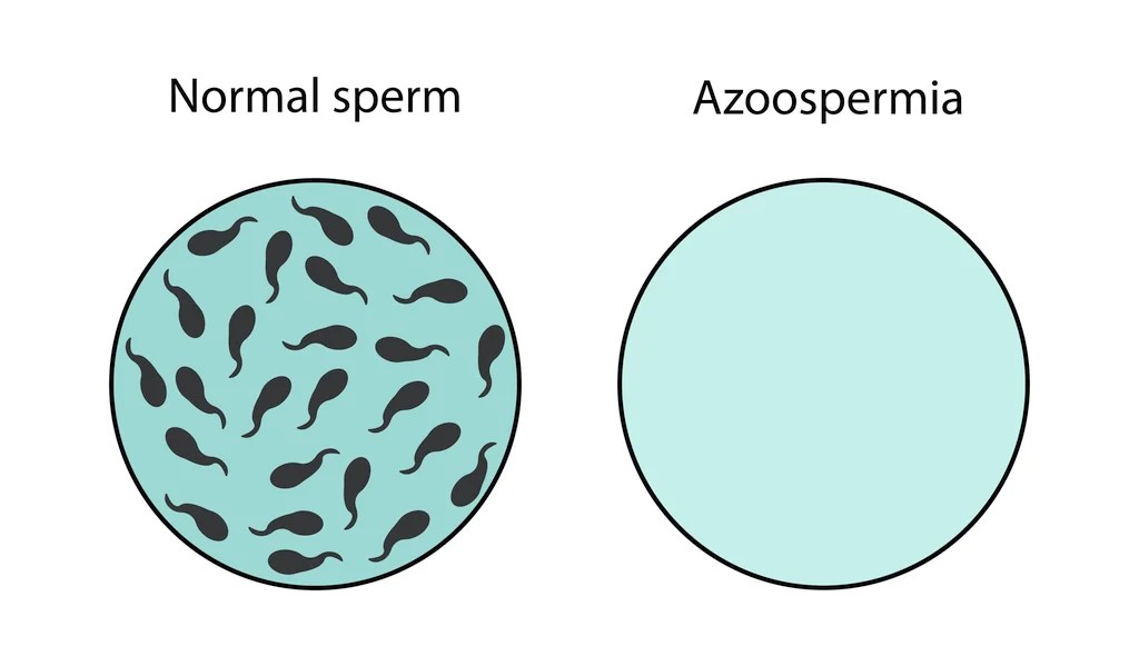 Azoospermia Causes, Diagnosis and Treatments