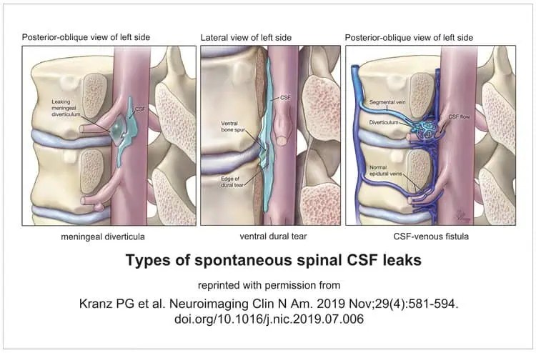 Cerebrospinal Fluid Leak Spine