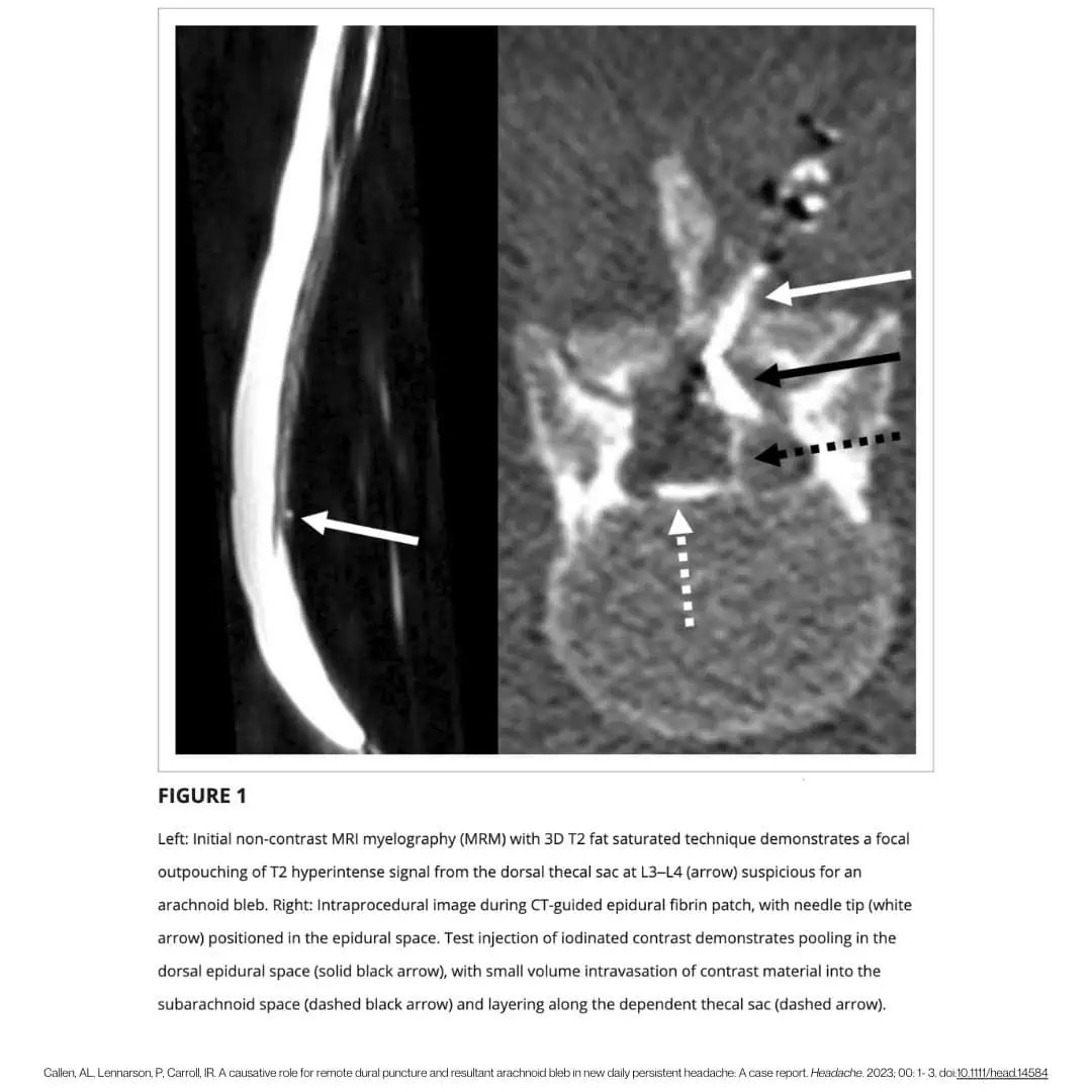 After 18 years, a proper diagnosis—and treatment Spinal CSF Leak