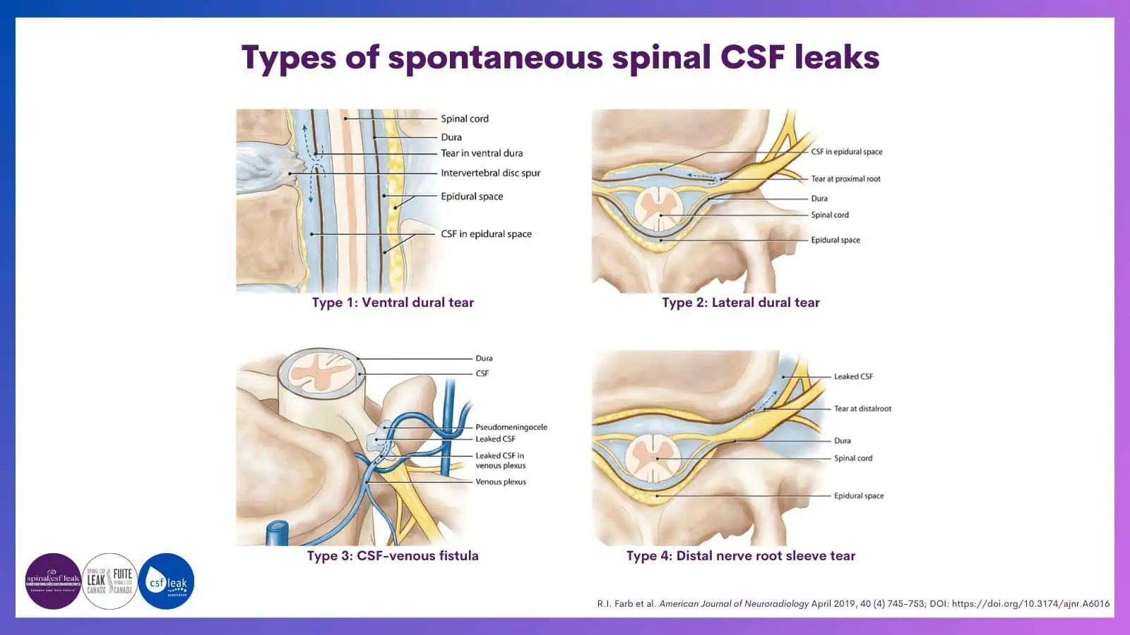 types Spinal CSF Leak Foundation