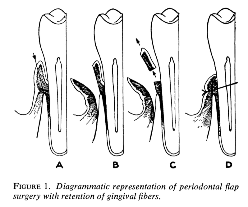 33 GINGIVAL FLAP SURGERY GeauxPerio