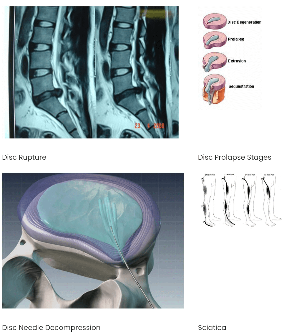 Slip Disc & Sciatica Spine Disc & Pain Specialist Dr. Neeraj Jain