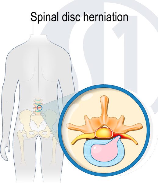 Disc Protrusion Treatment at Spine One Denver Spine Pain Specialists
