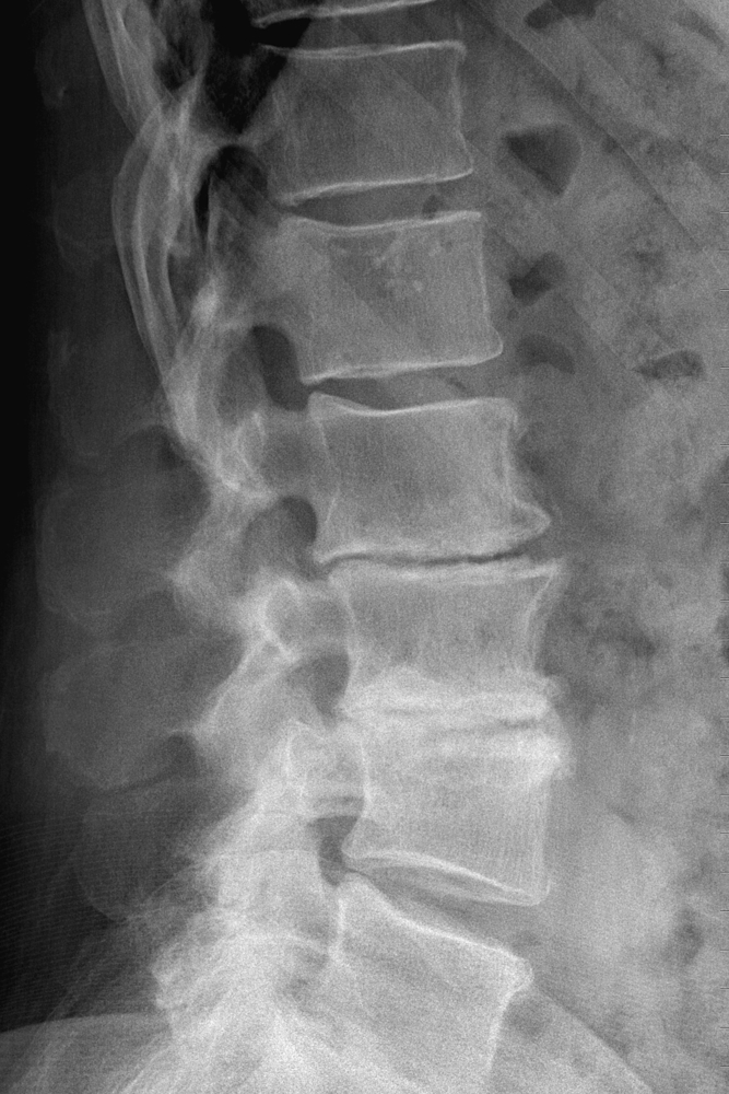 Spine Scan Chiropractic Care for Degenerative Disc Disease Perth