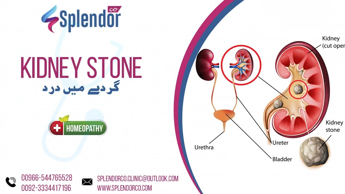 Homeopathic Medicines for Kidney Stones
