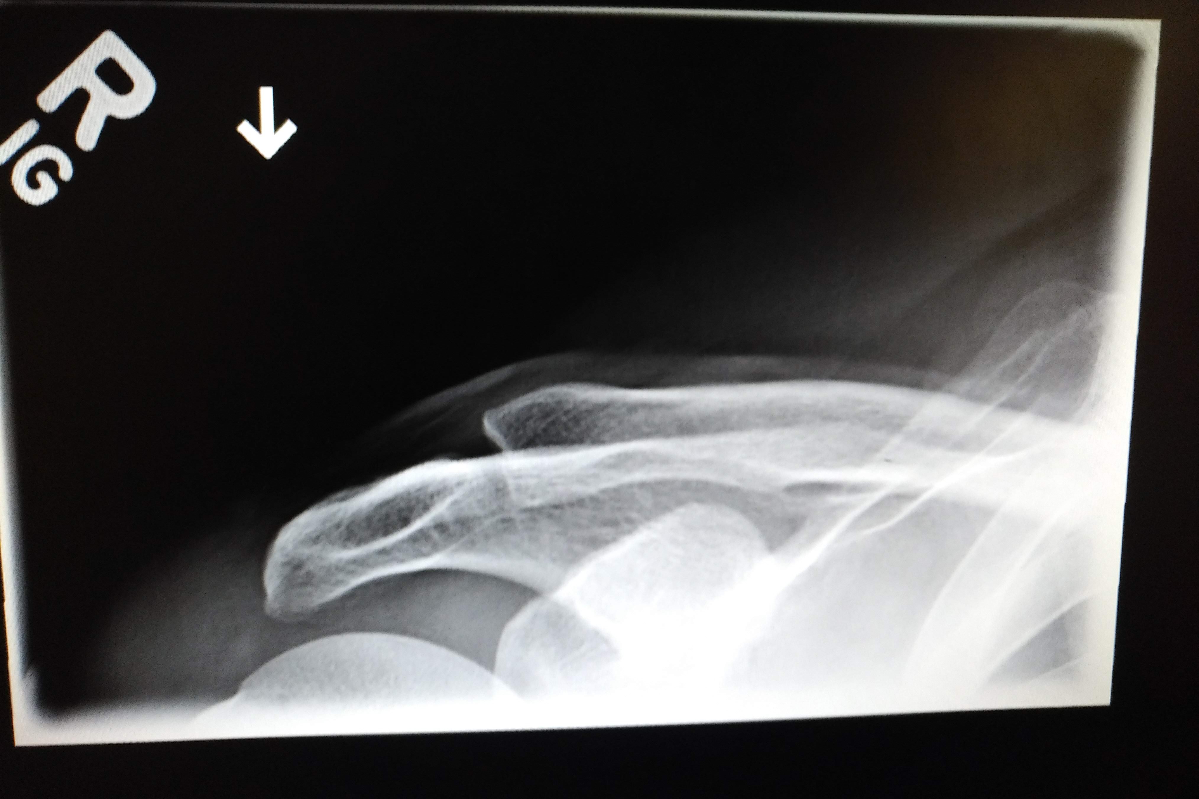 Osteolysis of Distal Clavicle Sport Med School