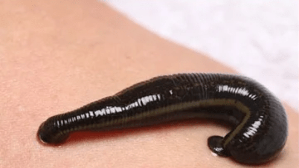 Leech Therapy Benefits Explained Holistic Healing Insights
