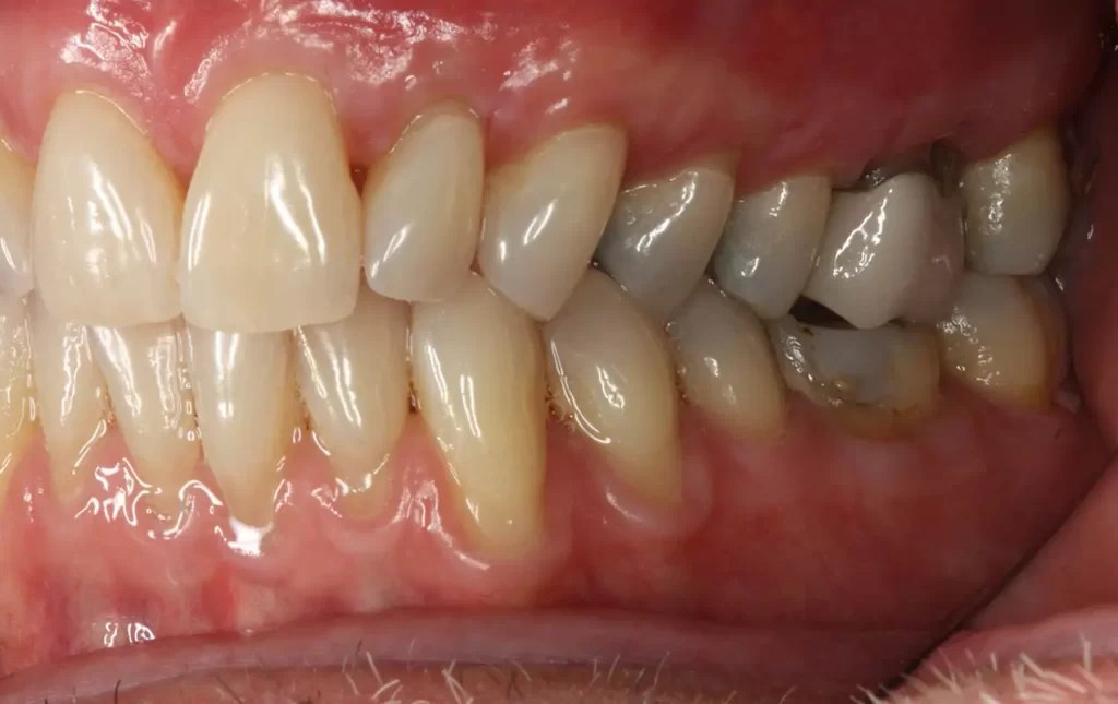 Before And After in Racine, WI Spring Dental Group