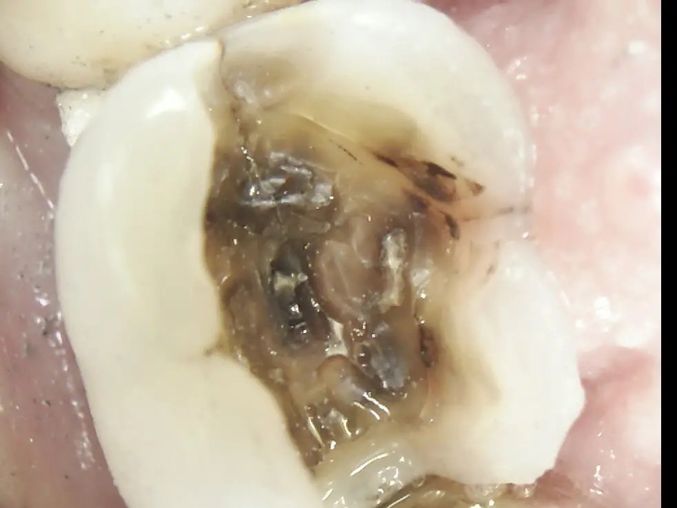 Before And After in Racine, WI Spring Dental Group