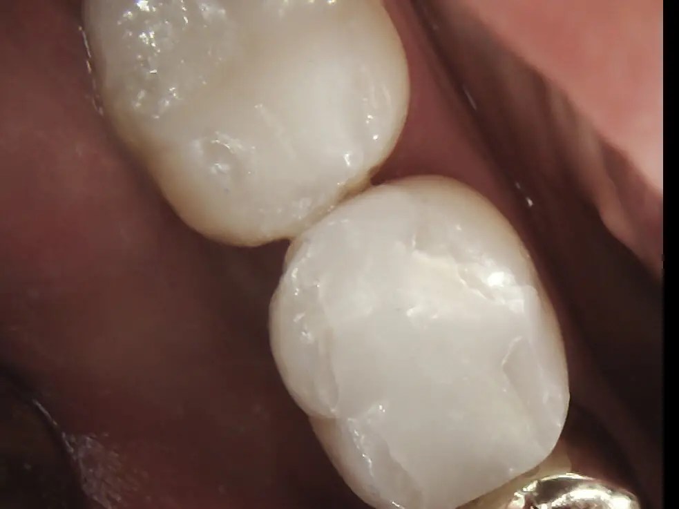 Before And After in Racine, WI Spring Dental Group