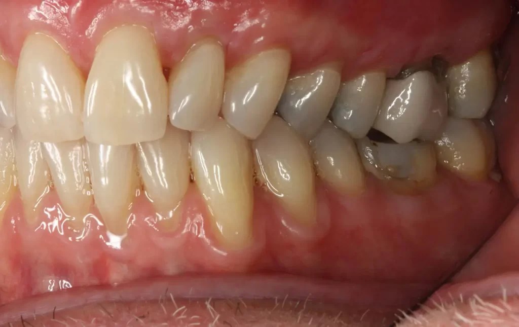 Regenerate Gum and Bone in Racine, WI Spring Dental Group