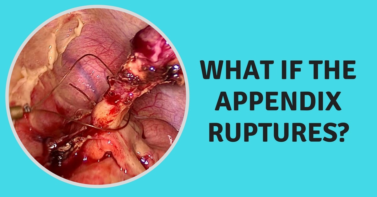 What happens if appendix bursts Appendix surgery in Chennai Dr Maran