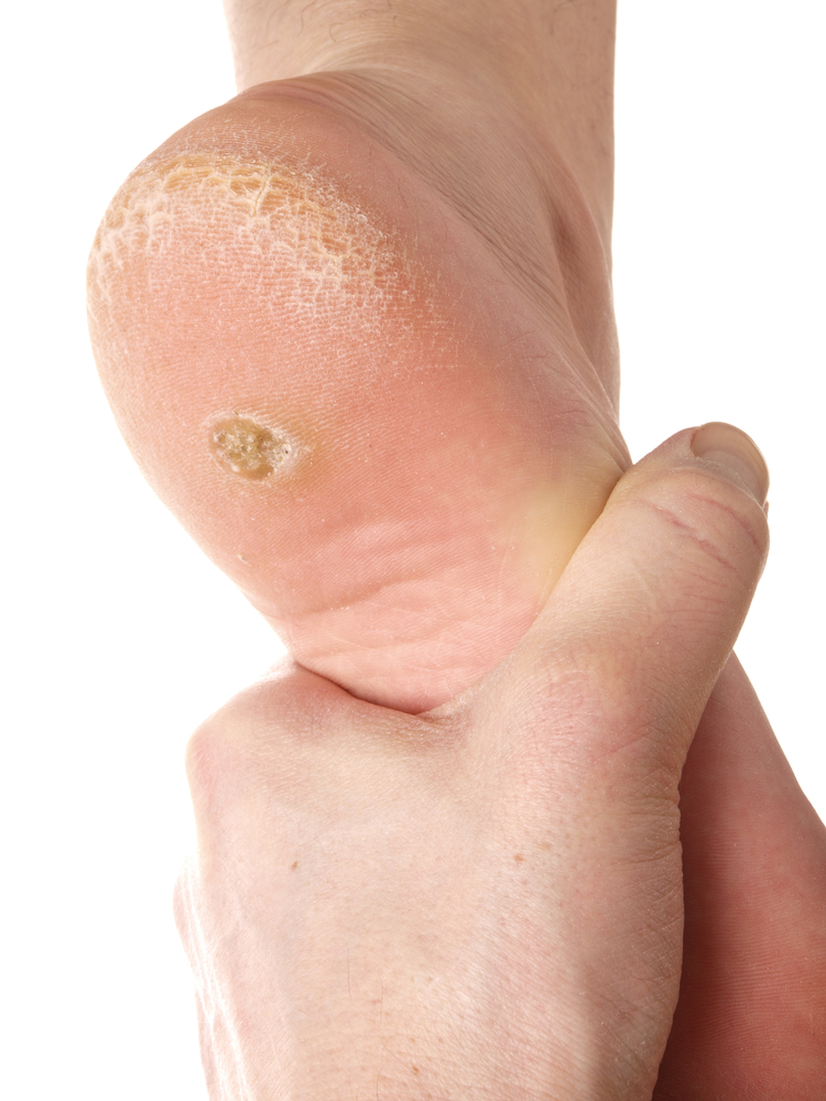 Plantar warts are caused by the sa. Verruca Treatment | Springhead Chiropody and Podiatry