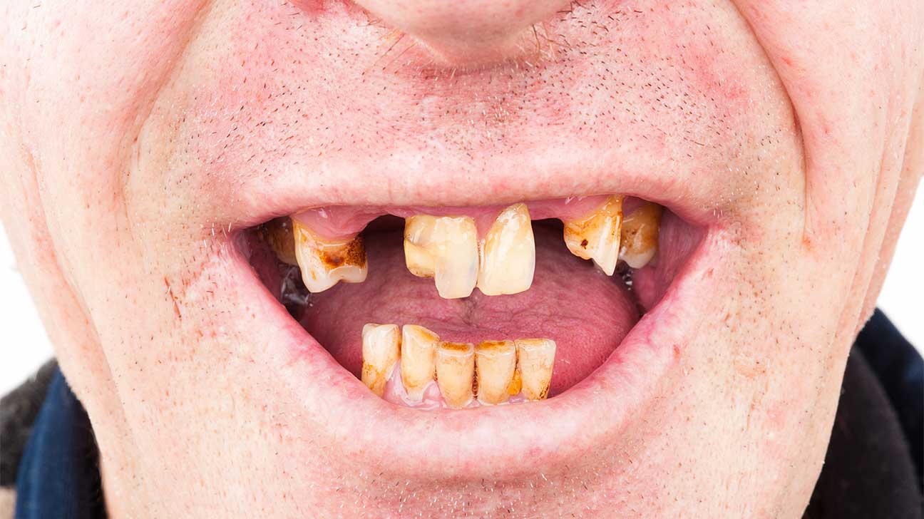 What Are Heroin Teeth? Spring Hill Recovery