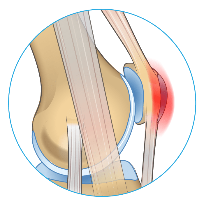 Knee Pain on the Front of Your Joint? Learn Why. Spring Loaded Technology