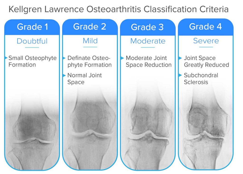 Guide to Severe Knee Arthritis Osteoarthritis