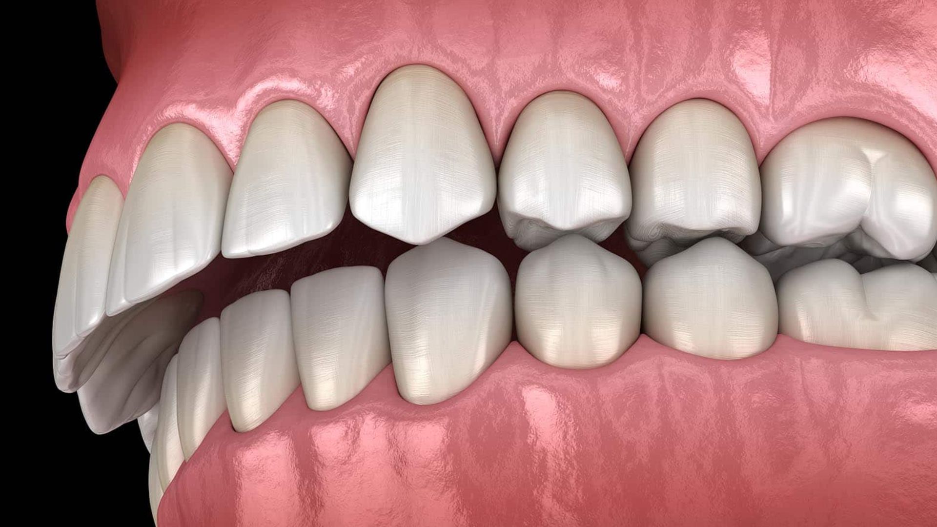 Overbite Treatment At Spring Orchid Dental, Bassendean