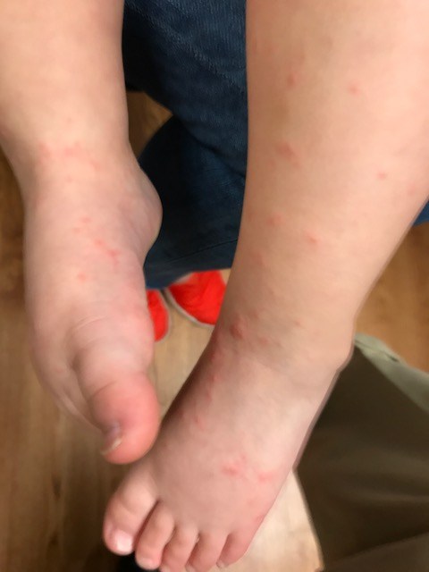 The Dreaded Virus - Hand Foot And Mouth Disease - Spring Valley Pediatrics