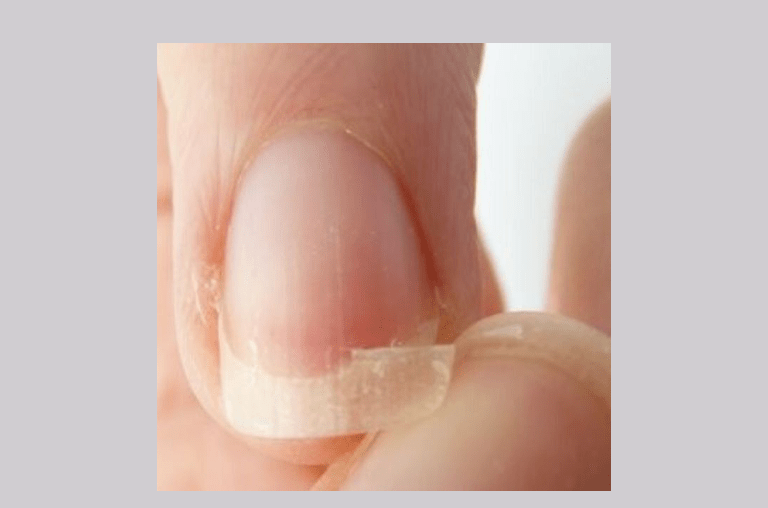 Texture And Color Of Fingernails A Health Indicator!