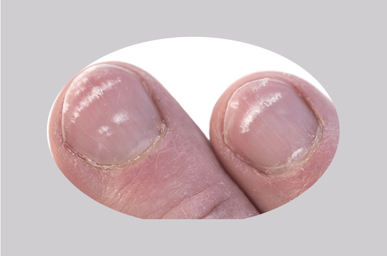 Texture And Color Of Fingernails A Health Indicator!