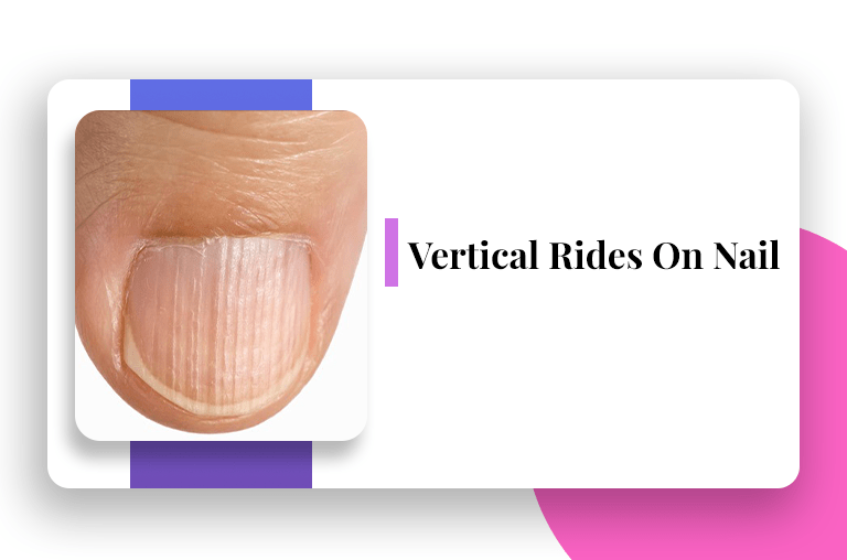 Vertical Ridges On Nails What Does It Say About Your Health?