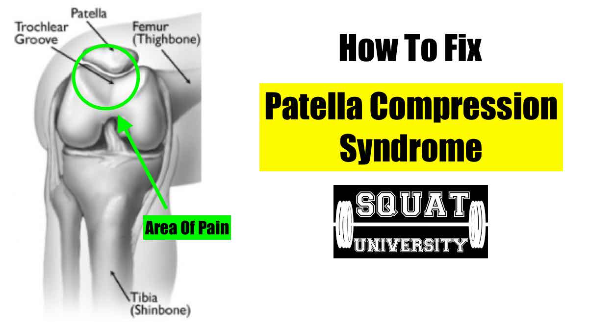 How to Fix Patellar Compressive Syndrome Squat University