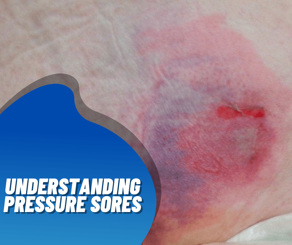 Elderly Pressure Sores Prevention and Treatment SR Parents