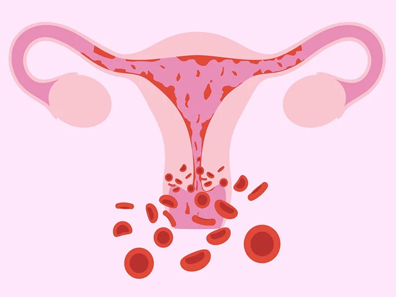 Heavy Bleeding srishtifertility