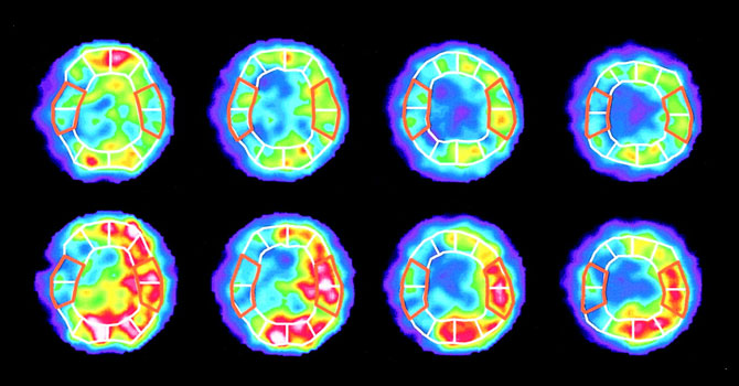 SPECT Nuclear Medicine SRMS FIMC Lucknow
