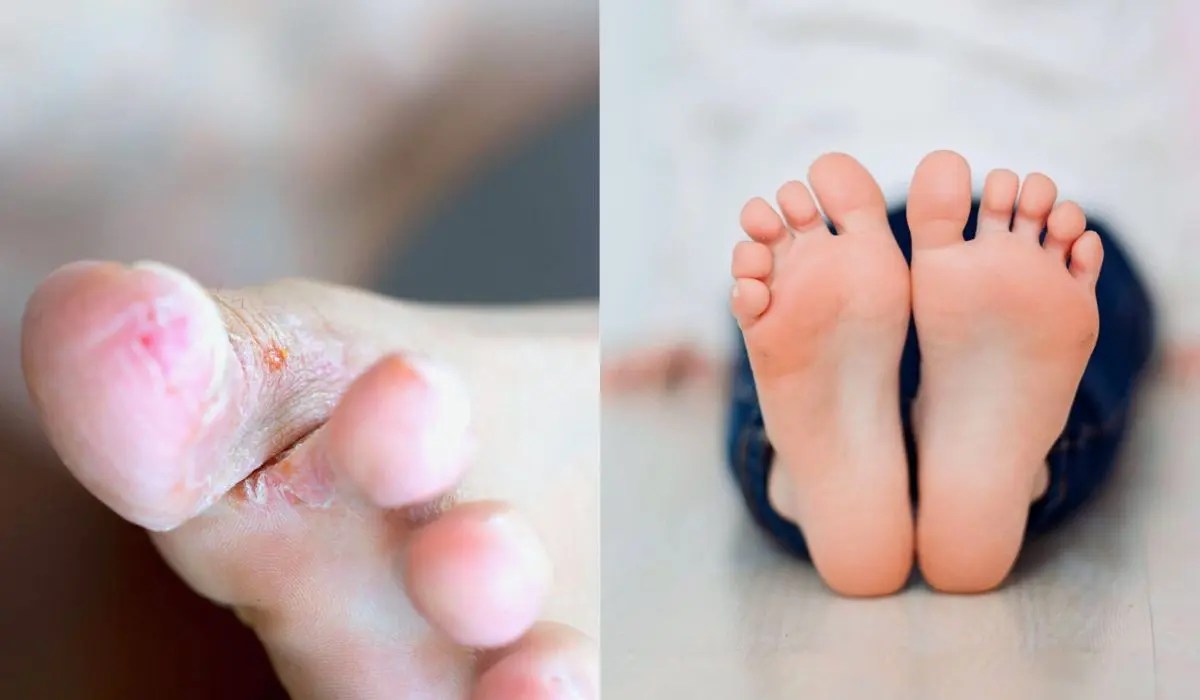 What Is The Cause Of Foot Fungus? Root Causes Explained